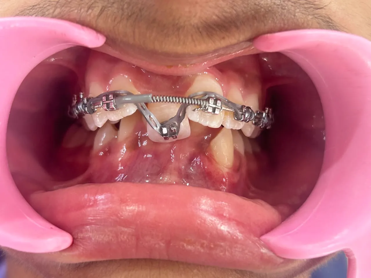 Precision Metallic Braces Alignment