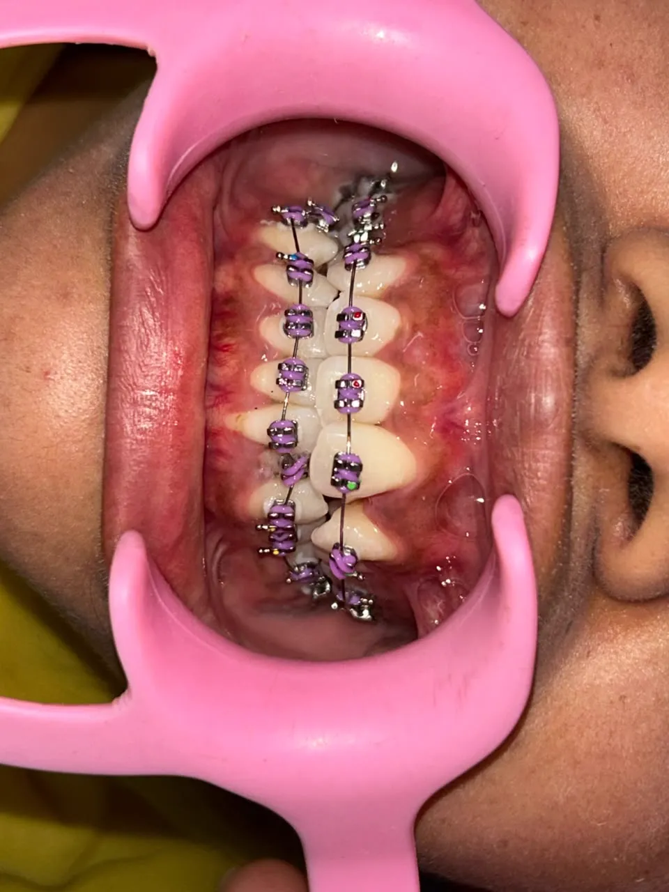 Ceramic Orthodontic Bracket Placement